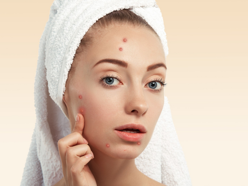 Acne Treatment