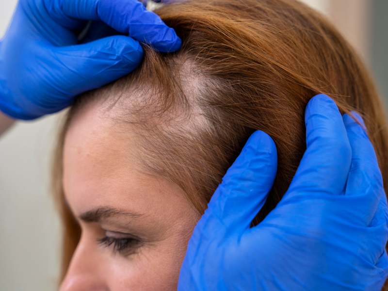 Hair Fall Treatment