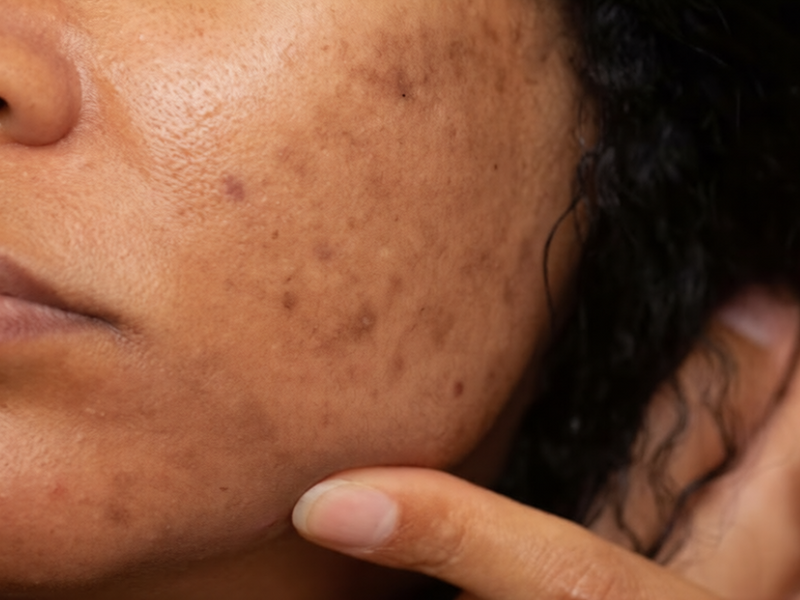 Dark Spot Treatment